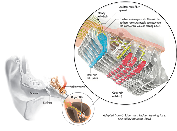 Hidden hearing loss, adapted from C. Liberman, Scientific American, 2015