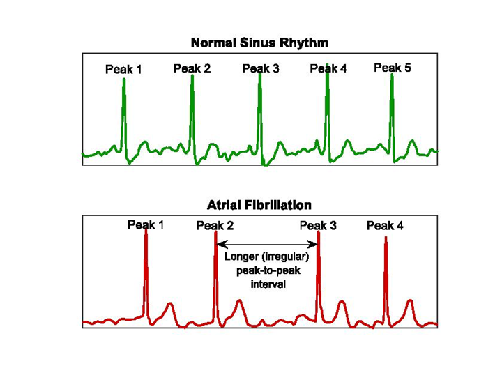 ECG graphs